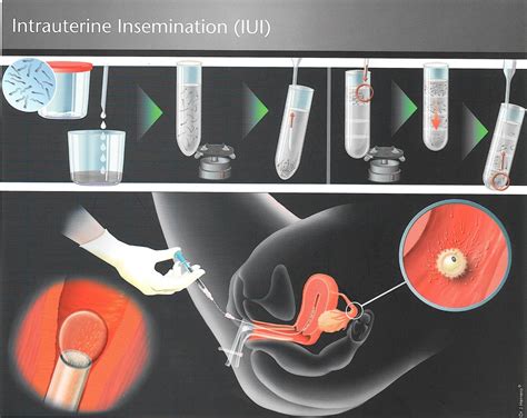 insemination porn|insemination videos